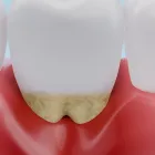 歯周病について